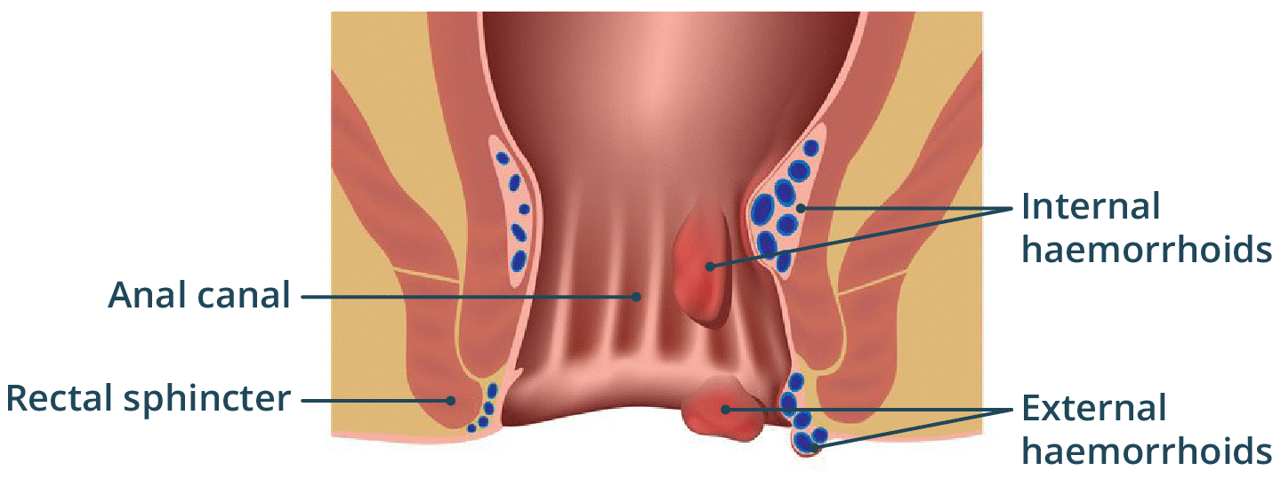 carl anthony padua add Anal Tummy Bulge photo