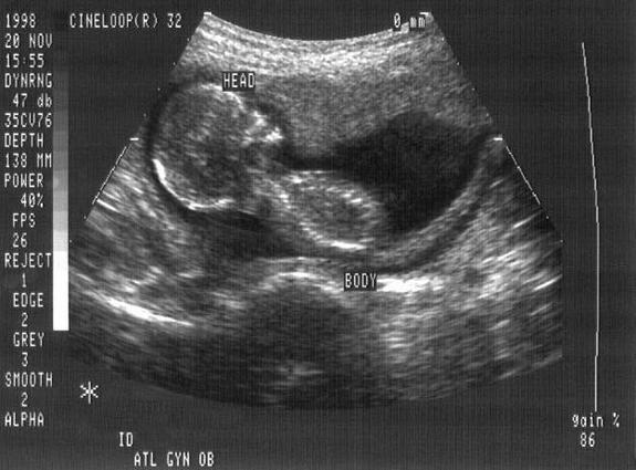 arichada ngamwongsathit add Porn Ultrasound photo