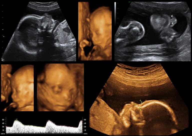 alvin ratliff add 3d Pregnancy Porn photo
