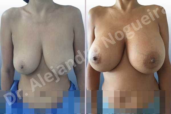 dave de jong add Teardrop Breasts Nude photo