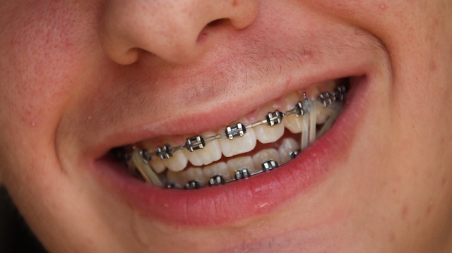 alex nowik add Twinks With Braces photo
