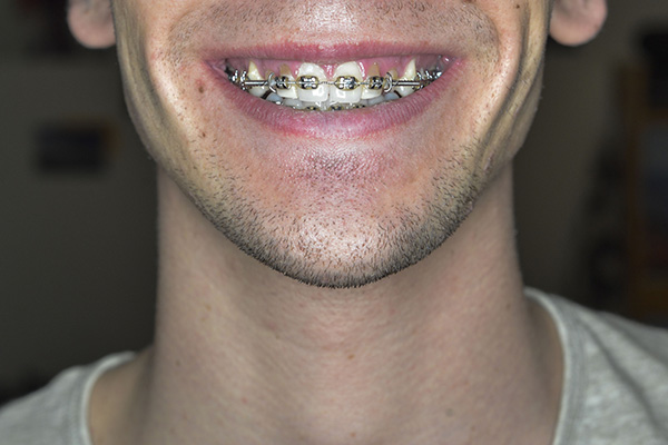 andrew azmy add Twinks With Braces photo