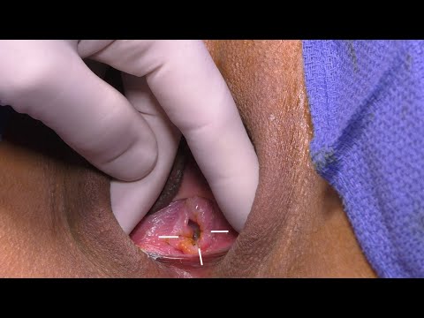 bryan miley add Broken Hymen Video photo