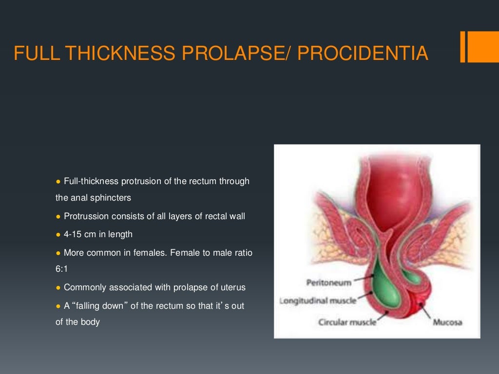 david fronczak add Public Anal Prolapse photo