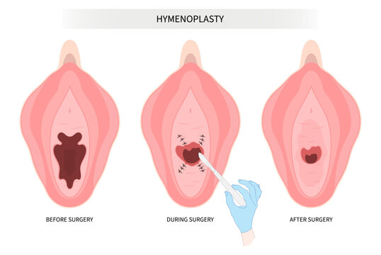 christopher rucker add Broken Hymen Video photo