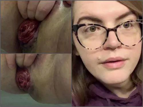 benjy bryan aribal add Public Anal Prolapse photo