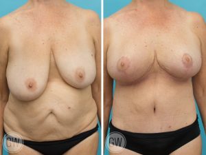 Saggy Tits Small 14107