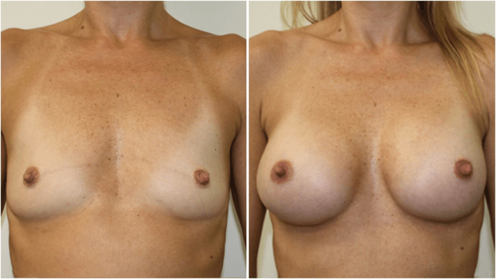 albert tandra add Tear Drop Boobs Nude photo