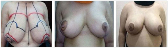 bill person add Upturned Tits photo